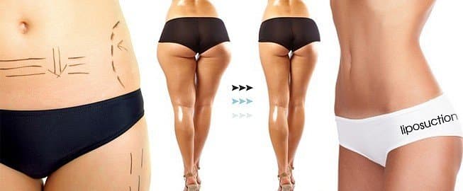 Neinvazivní liposukce + lymfodrenáž zdarma