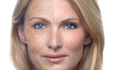 Botox – korekce mimických vrásek