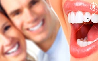 Aplikace dentálního šperku