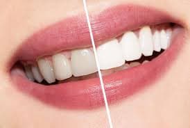 Pečlivá dentální hygiena či šetrné bělení zubů