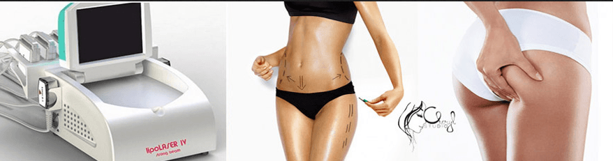 Zeštíhlující laserové liposukce LIPO laserem IV 