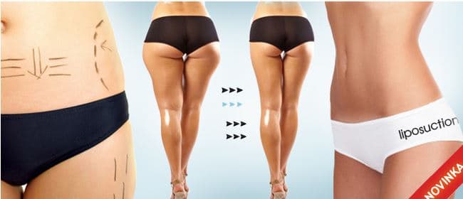 Bezbolestná LIPOSUKCE 3 generace + LYMFODRENÁŽ