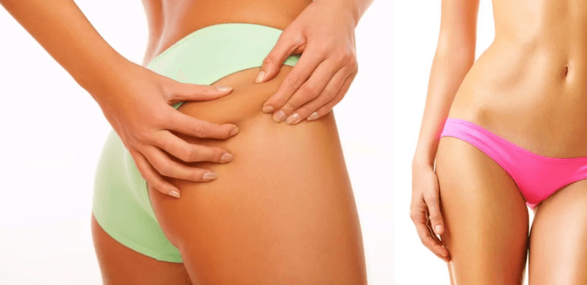 Ultrazvuková liposukce a lymfodrenáž