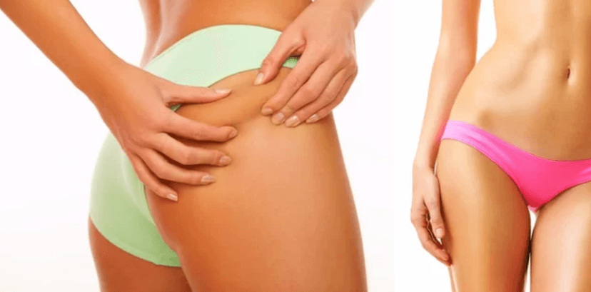 Hubnutí ultrazvukovou liposukcí a lymfodrenáží