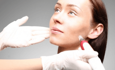 Ošetření tváře a krku metodou microneedling