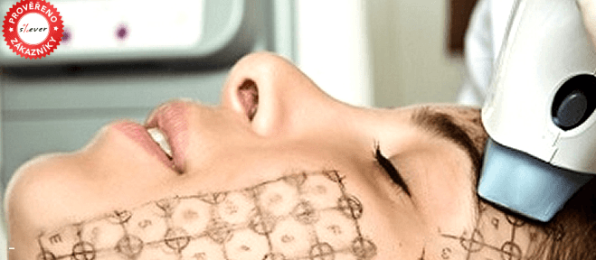 Thermage CPT - neinvazivní facelift 