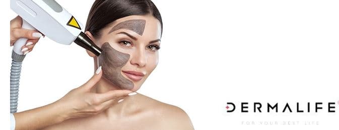 Exkluzivní kosmetické ošetření - Carbon Peel laser