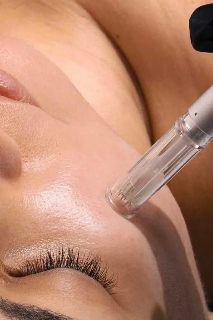 Mikrojehličkování Dermapenem: hloubková obnova pleti, 1 nebo 3 ošetření