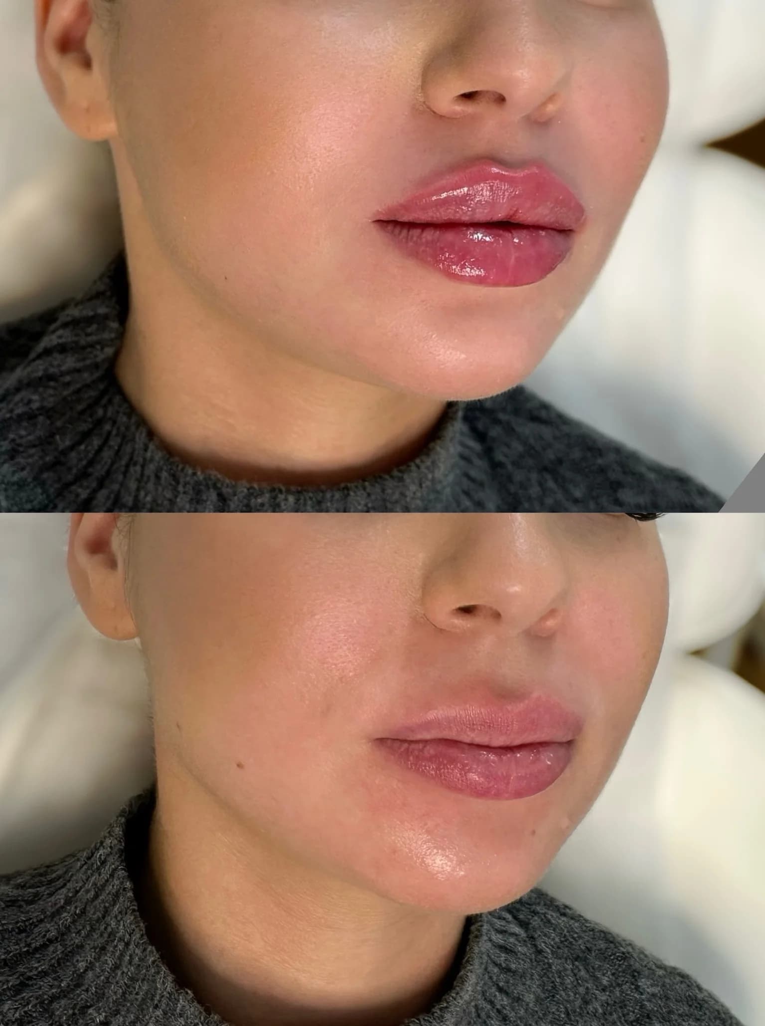 Omlazující výplně: aplikace botulotoxinu, kyseliny hyaluronové a polymlečné kyseliny