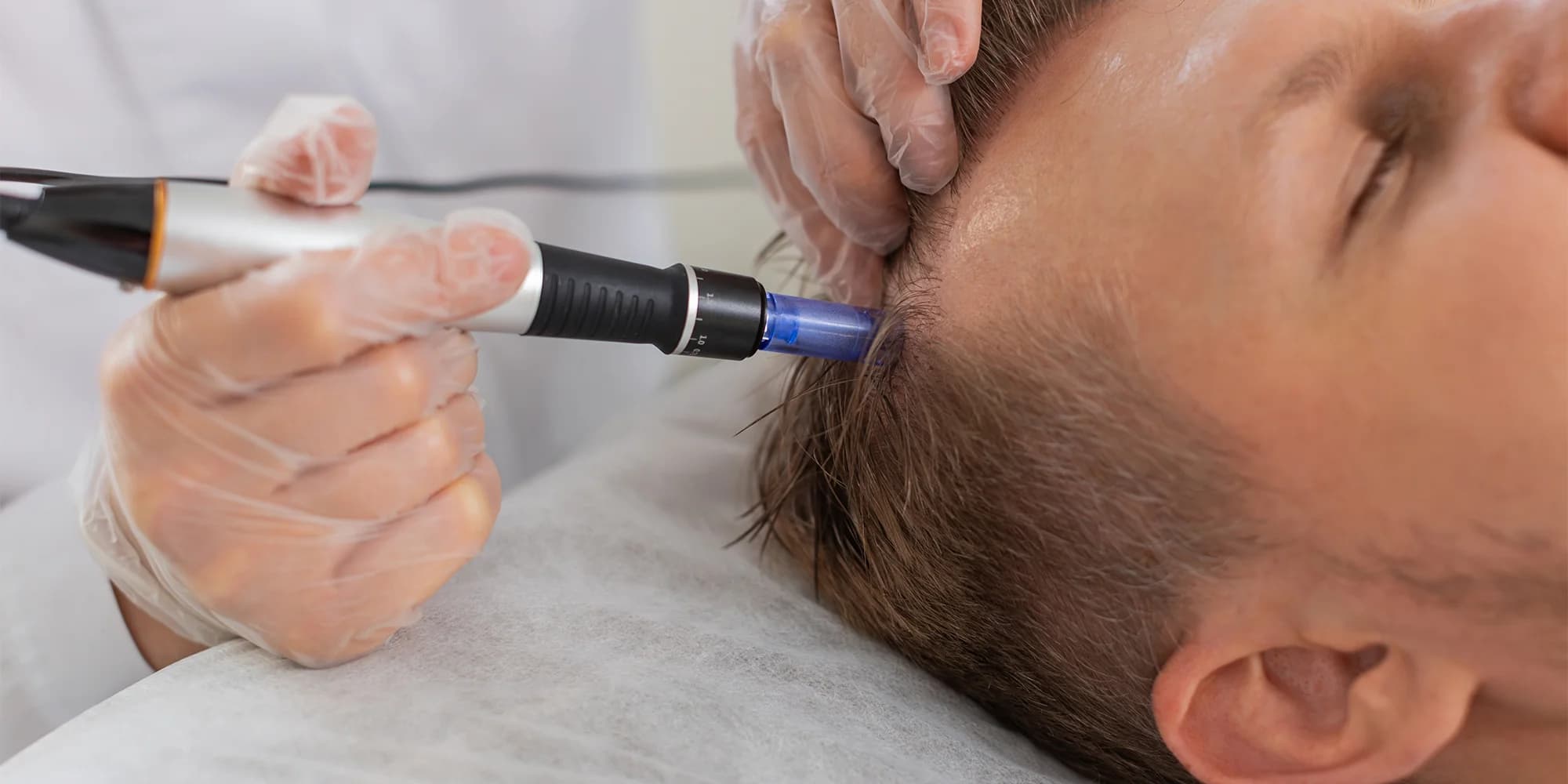 Podpořte zdravý růst vlasů: aktivační mikrojehličkování vlasové pokožky