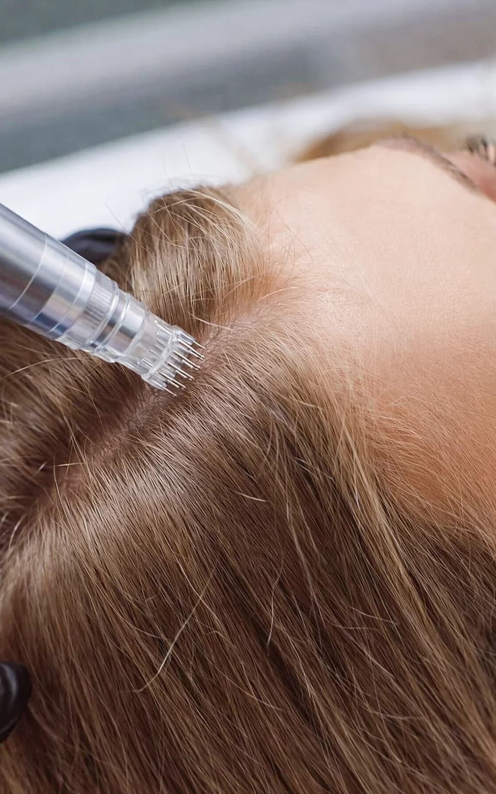Mezoterapie proti vypadávání a řídnutí vlasů: komplexní kúra včetně konzultace