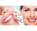 Bělení zubů neperoxidovým gelem | KupDnes