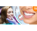 Neperoxidové bělení zubů modrým laserem!  | Hyperslevy