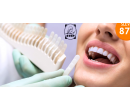 Neperoxidové bělení zubů  | Hyperslevy