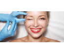 Vyhlazení či úprava mimických vrásek v obličeji  | Slevomat