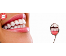 Neperoxidové bělení zubů přístrojem Whiten led | Slever